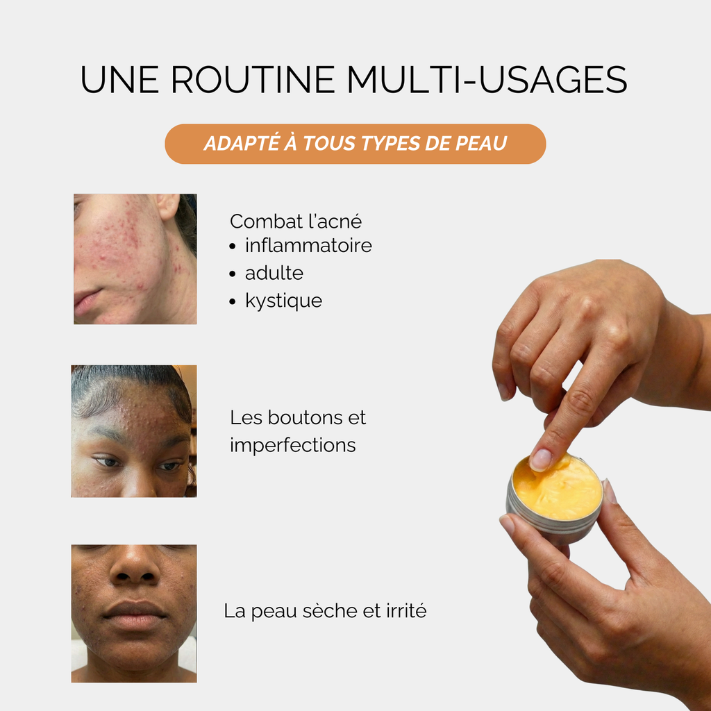 Baume de jour anti-acné
