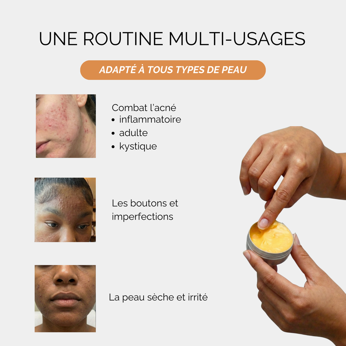 Baume de jour anti-acné