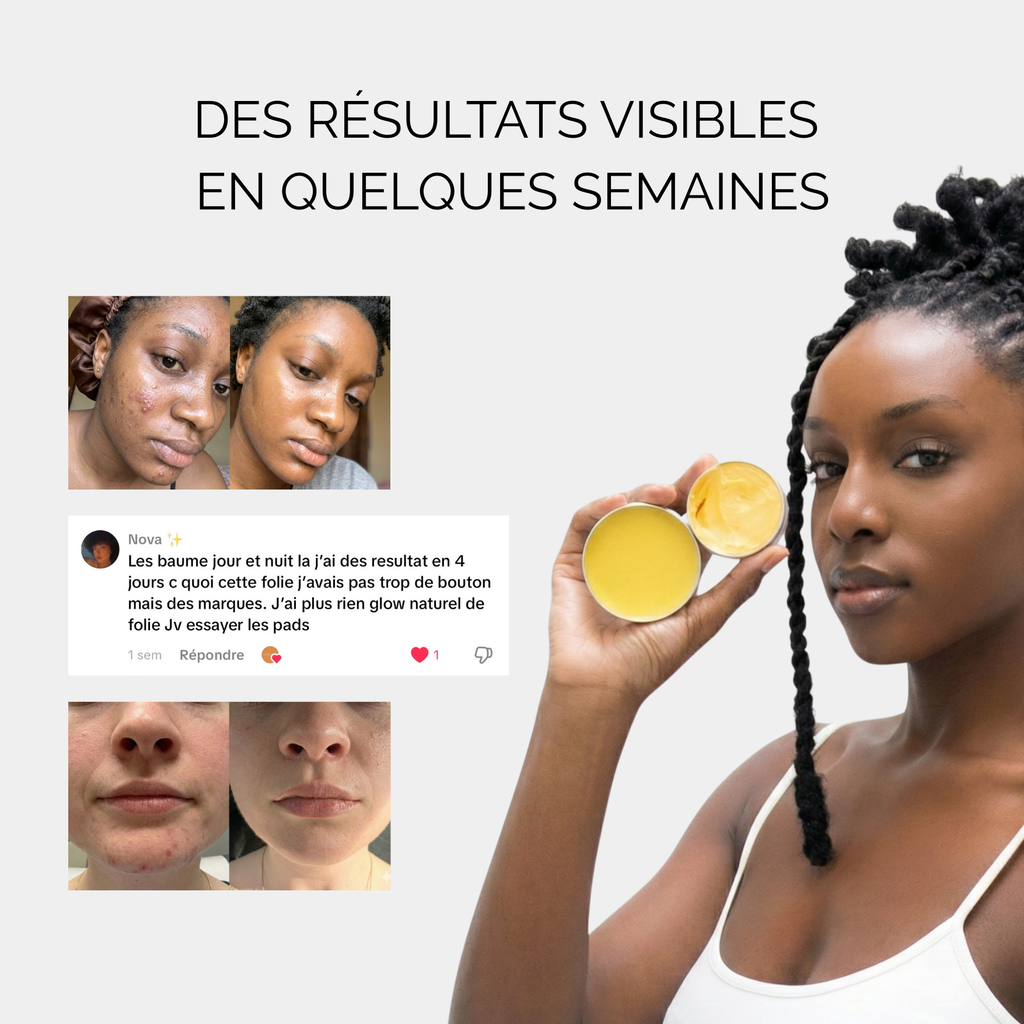 Baume de jour anti-acné