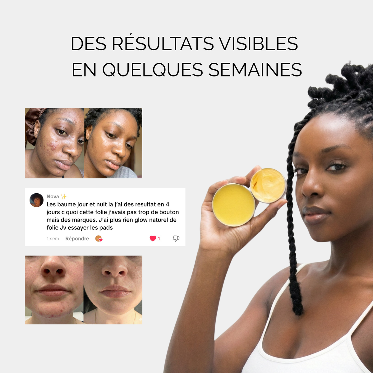 Baume de jour anti-acné